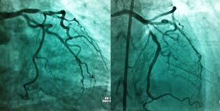 HEMODINAMICA E CARDIOLOGIA INTERVENCIONISTA